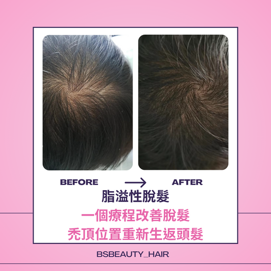 客人案例:脂溢性脫髮,一療程改善脫髮