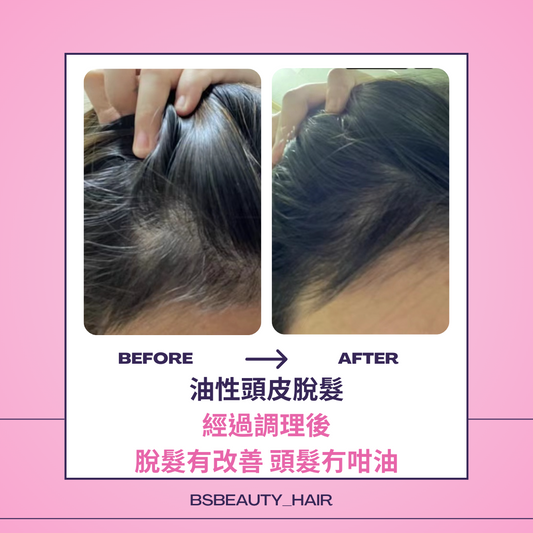 客人案例:油性頭皮脫髮,經調理後脫髮有改善
